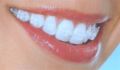 clear braces leatherhead|Clear Braces: Types, Cost, Alternatives & More.